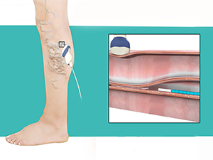 VenaSeal - KW Vein Clinic