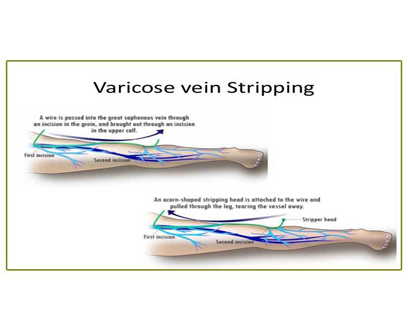 Varicose Vein Treatments, Guelph, ON