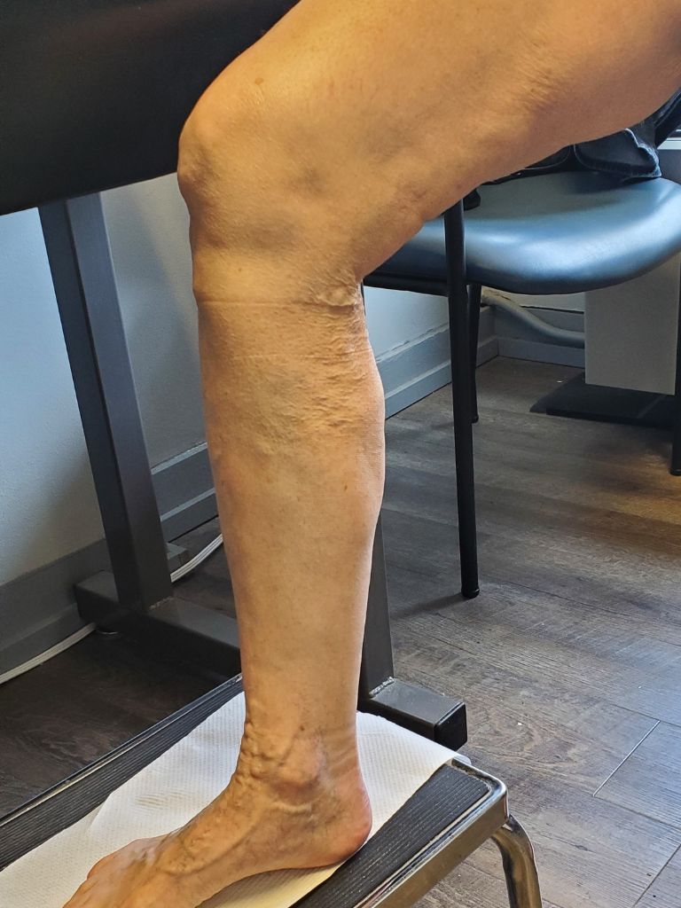 Right leg after treatment