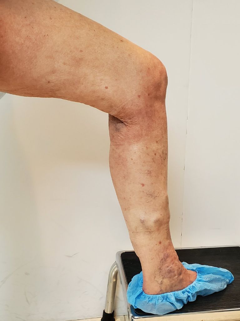 Left leg before treatment