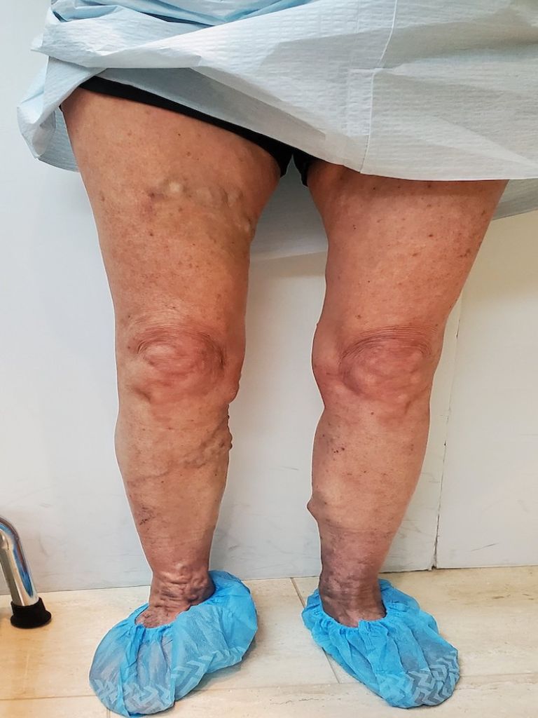 Both legs before treatment