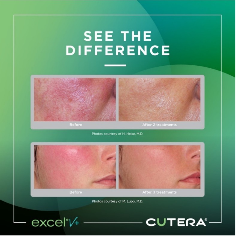 Rosacea Picture1