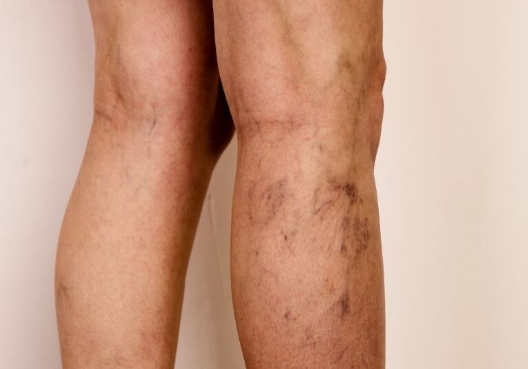 Spider Veins
